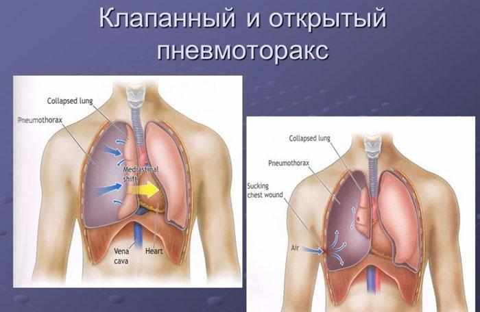 Клапанный и открытый пневмоторакс