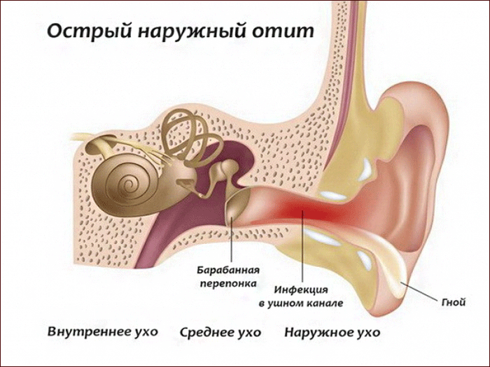 признаки наружного отита