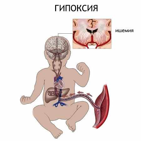 Гипоксия плода