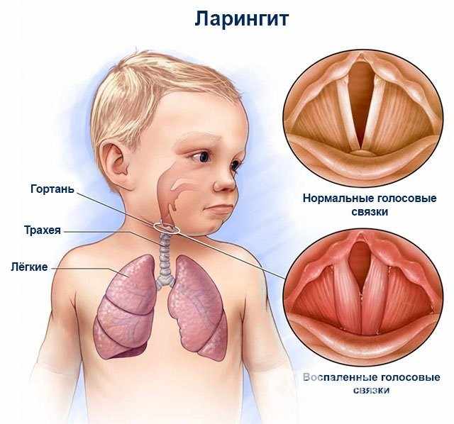 Ларингит и голосовые связки
