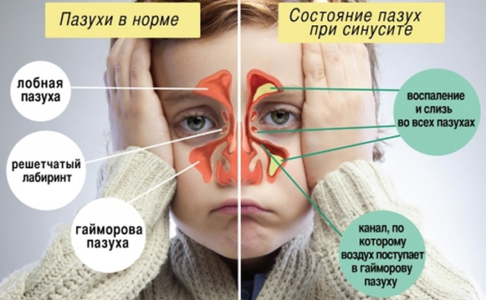 Пазухи носа при воспалении