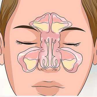 воспаление в пазухах носа