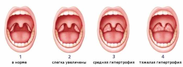 Степени аденоидов