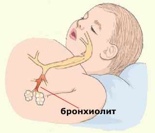 Бронхиолит у ребенка