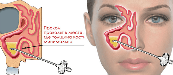 Прокол пазухи при гайморите