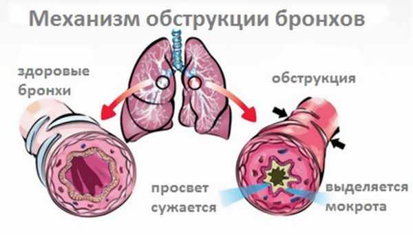 Развитие обструкции бронхов