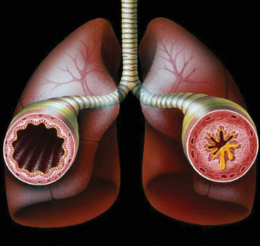 Бронхи при астме и бронхите