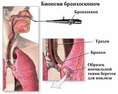 Бронхоскопия