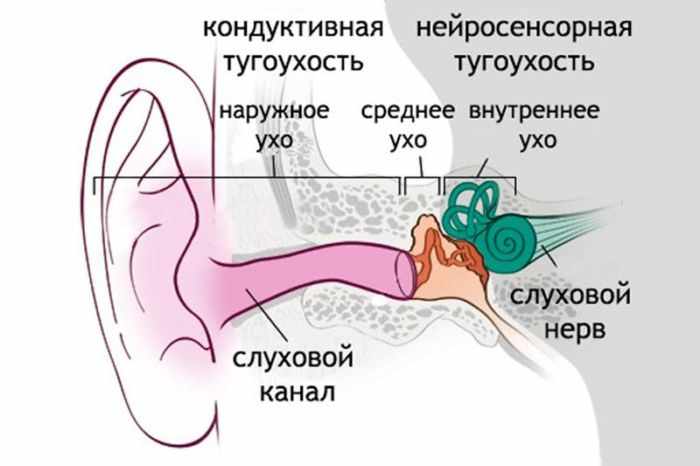 Виды тугоухости