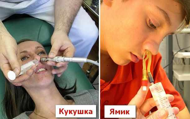 Фото метода кукушки и ЯМИК катетера