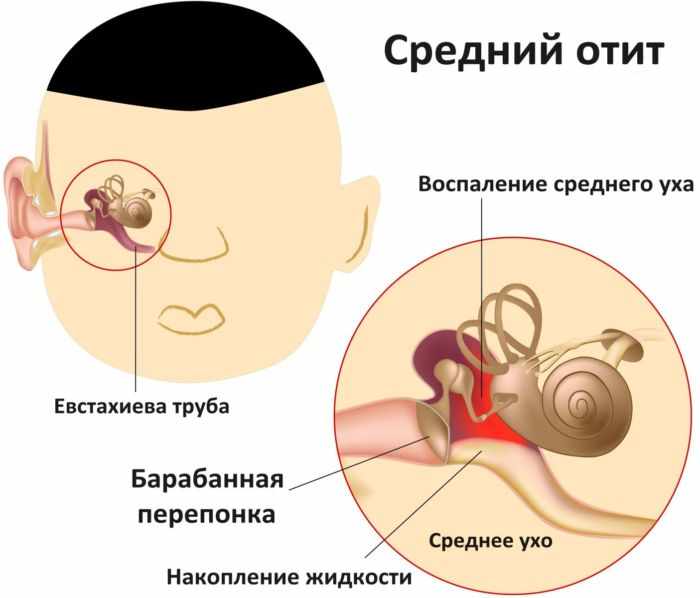Отит среднего уха