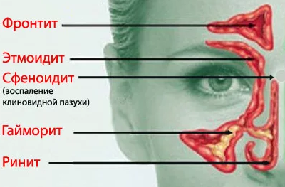 Болезни пазух носа