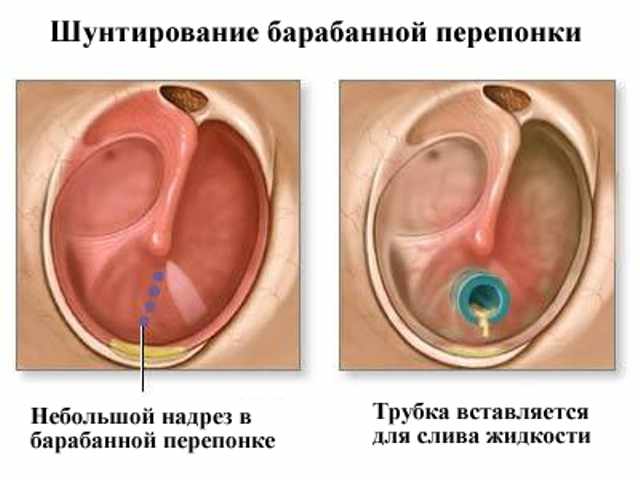 Парацентез барабанной перепонки