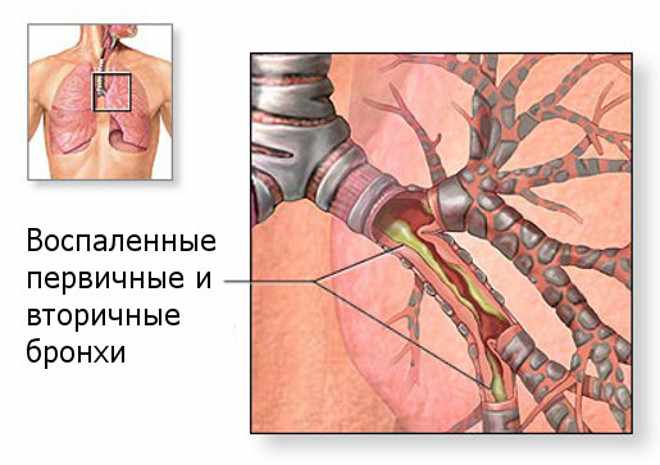 Воспаление бронха