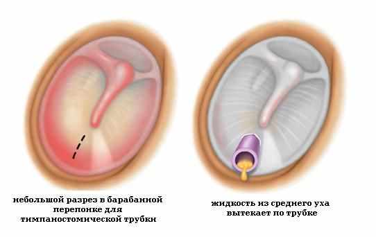 Миринготомия