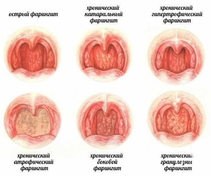 Виды фарингита