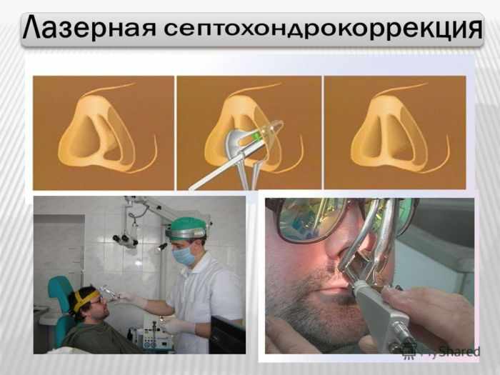 Cептохондрокоррекция
