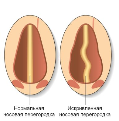 Искривление носовой перегородки