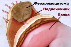 Феохромоцитома