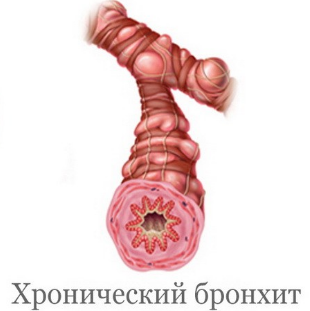 Бронх при хроническом бронхите