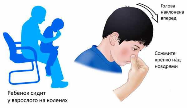 Помощь ребенку при кровотечении из носа