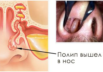 Полип в носу