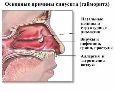 Причины гайморита