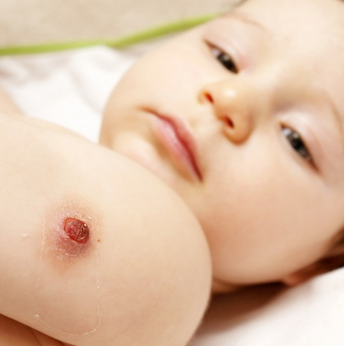 Аллергия на прививку от гриппа у ребенка