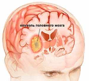 Опухоль мозга