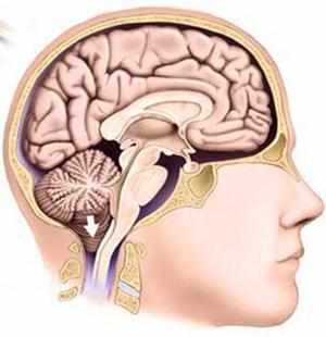 Нижняя часть мозга при синдроме Арнольда-Киари
