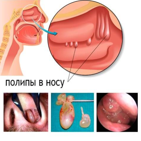 Полипы в носу