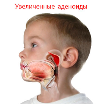 Аденоиды у ребенка