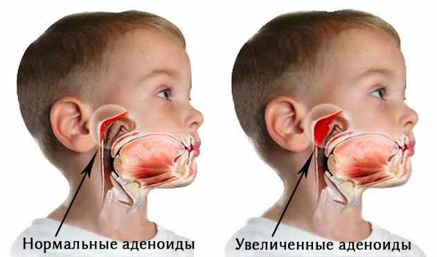 Развитие аденоидов