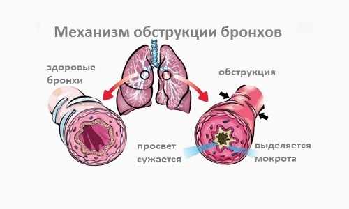 Механизм обструкции бронхов