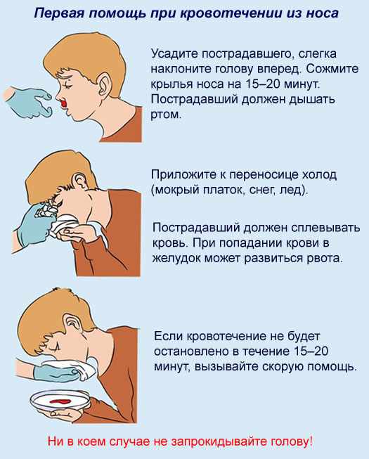 Этапы помощи при кровотечении из носа