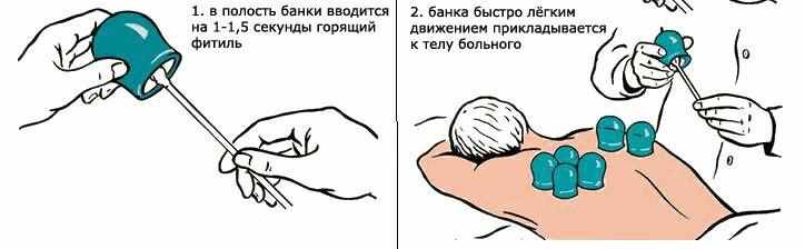 Ставят банки на спину