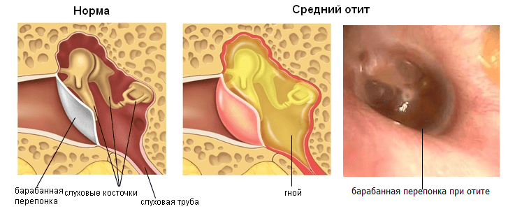 Фото барабанной перепонки при отите