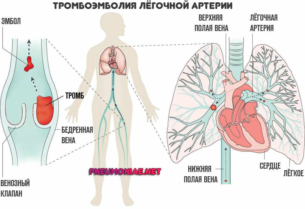 тромбоэмболия-легочной-артерии
