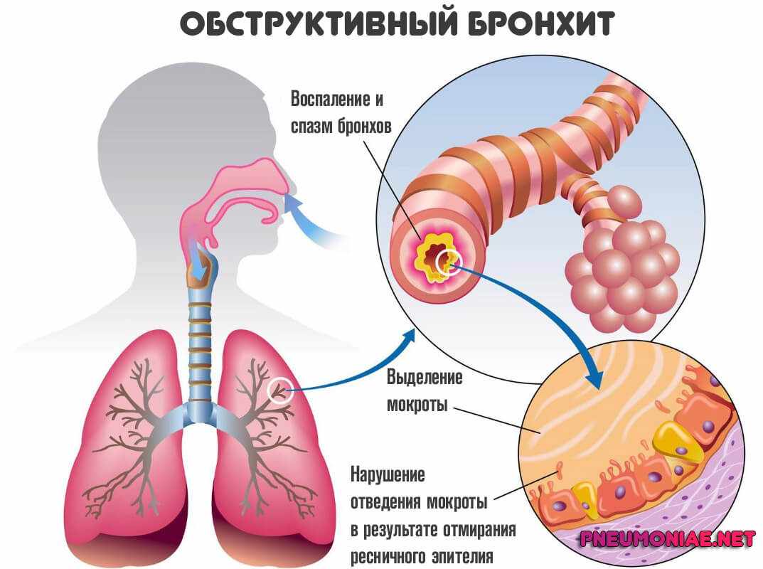 обструктивный-бронхит