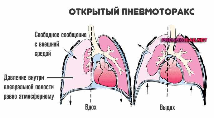 Физикальная картина при пневмотораксе характеризуется