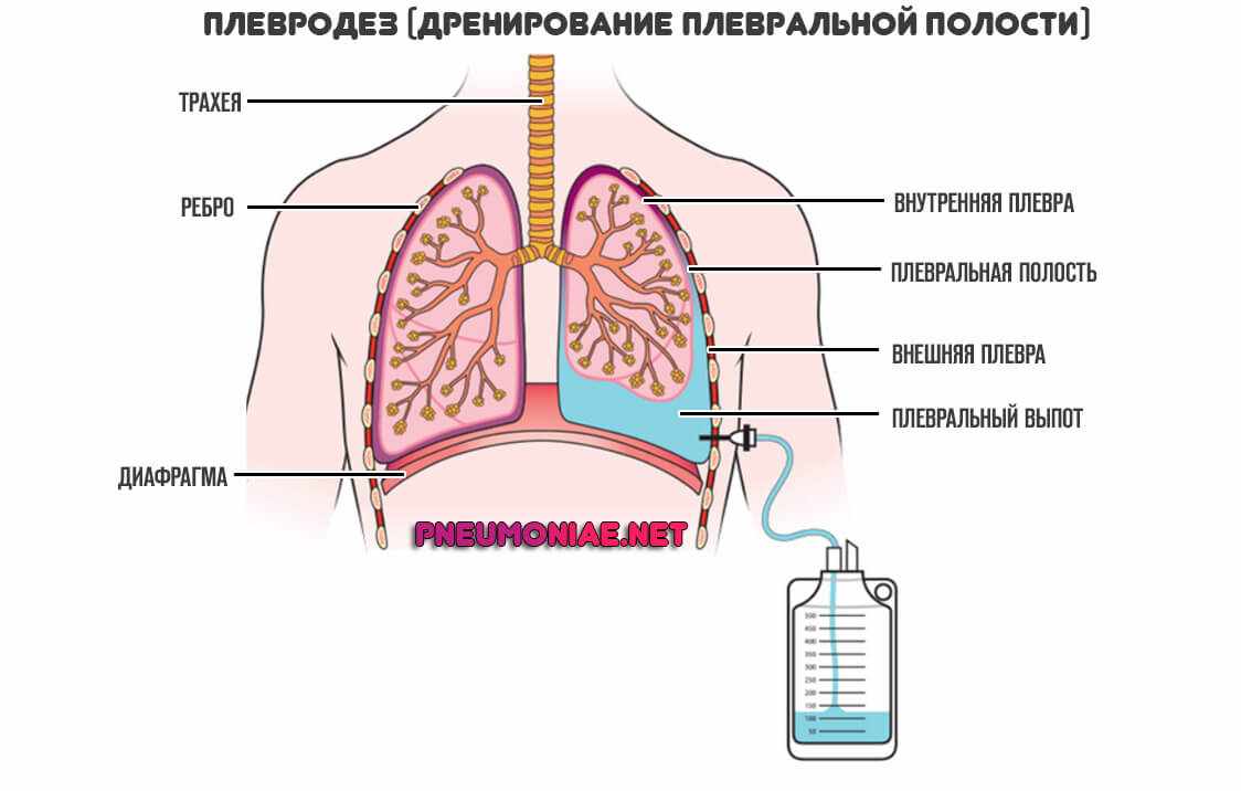 дренирование-плеврального-выпота