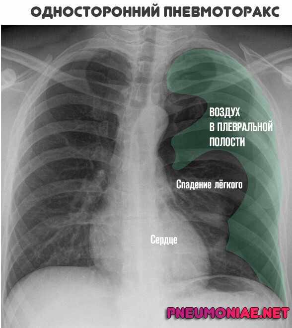Пневмоторакс легких. Спонтанный пневмоторакс рентген. Что такое пневмоторакс легкого у взрослого.