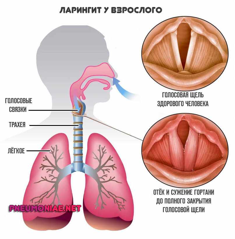 ларингит-у-взрослого