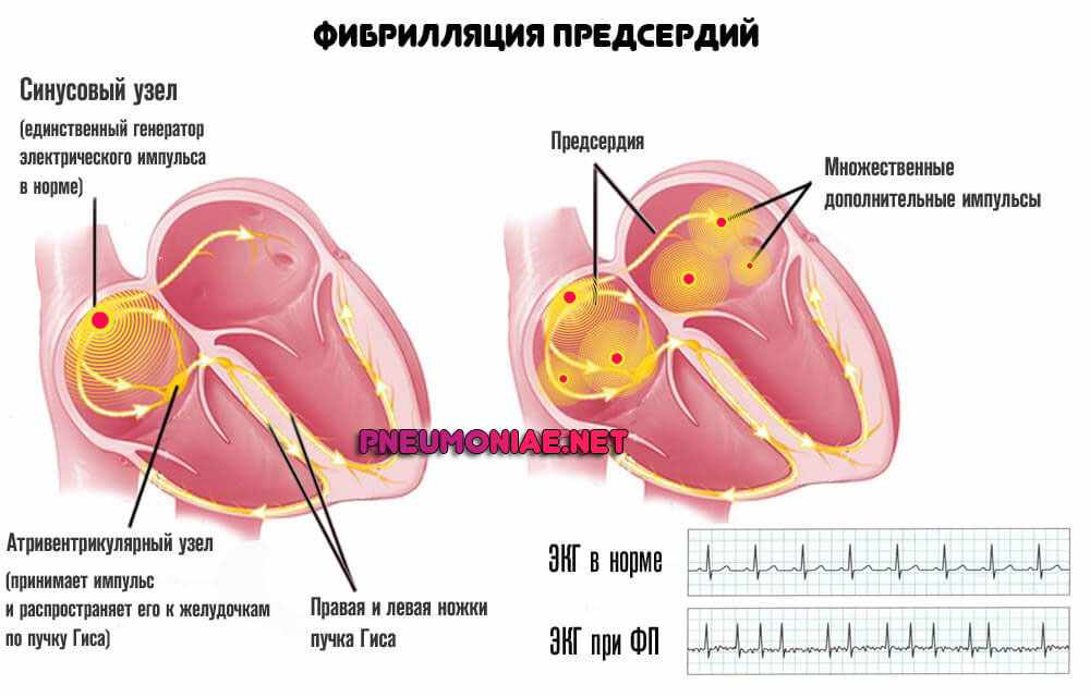 фибрилляция-предсердий