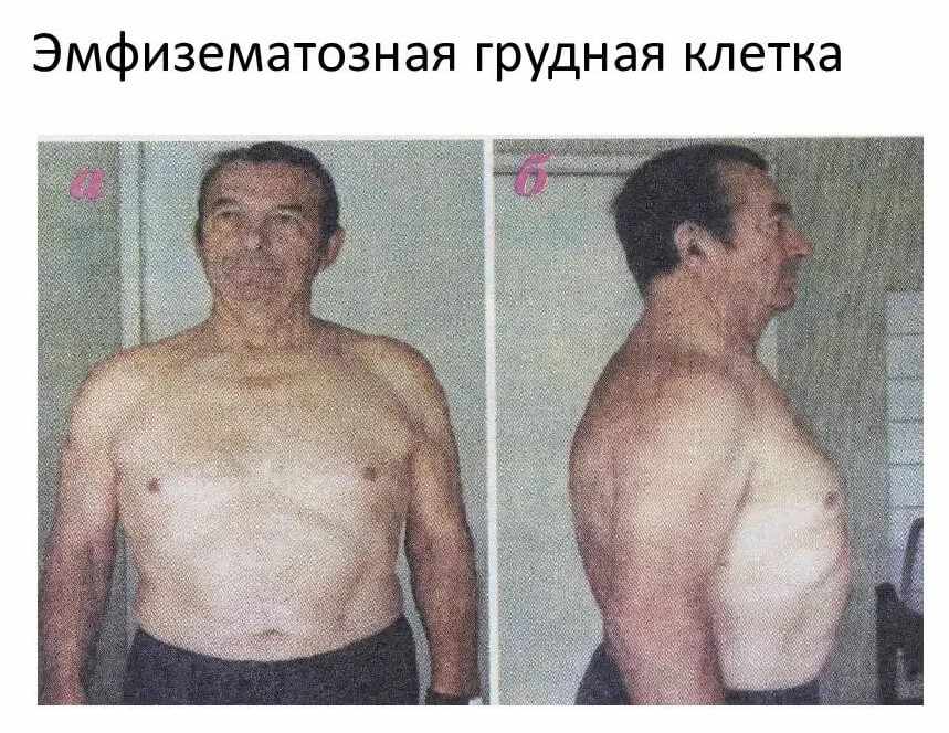 эмфизематозная грудная клетка