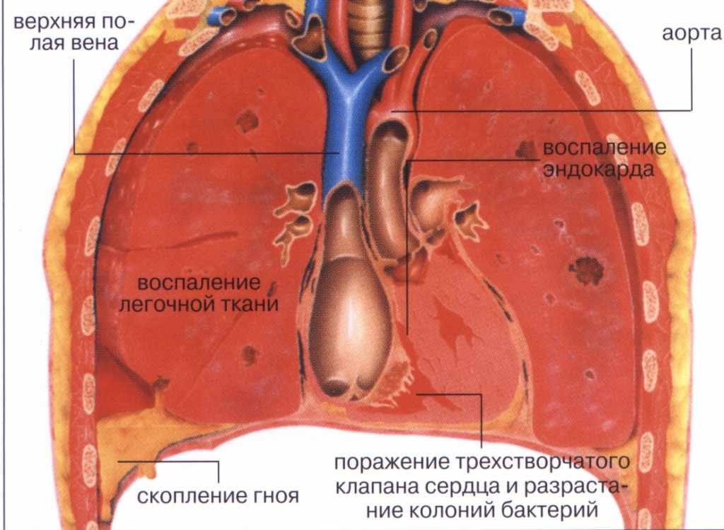 Пневмония - самое страшное заболевание современности