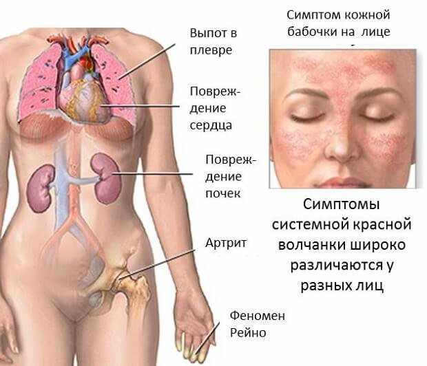 красная волчанка