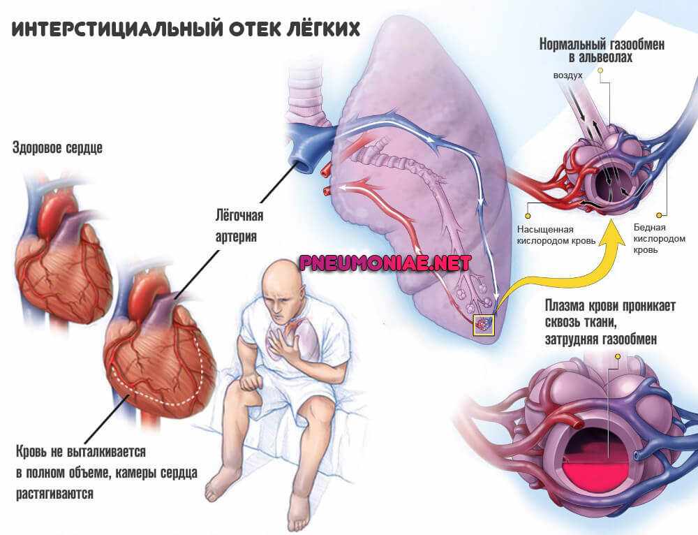 Интерстициальный-отек-лёгких