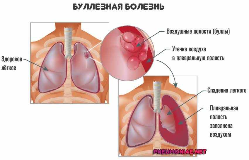 буллез