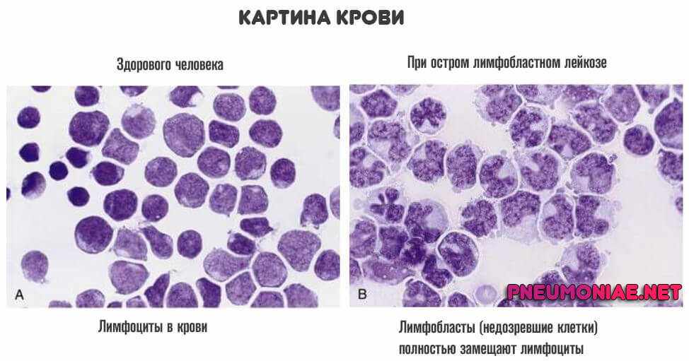 Реактивные изменения костного мозга. Острый лейкоз картина крови. Острый лимфобластный лейкоз мазок крови. Острый миелоидный лейкоз картина крови. Картина крови при остром лимфобластном лейкозе.